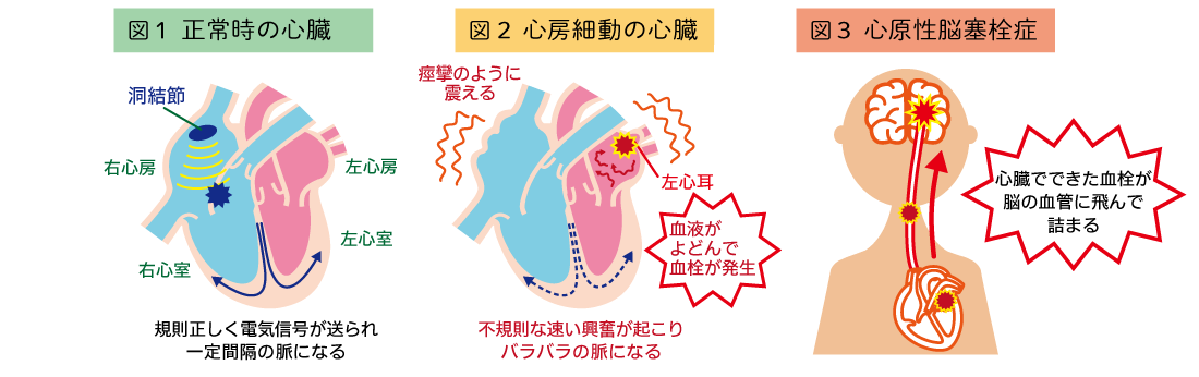 正常時の心臓と心房細動の心臓と心原性脳塞栓症の図