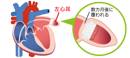 経カテーテル左心耳閉鎖術（ウォッチマン）の図